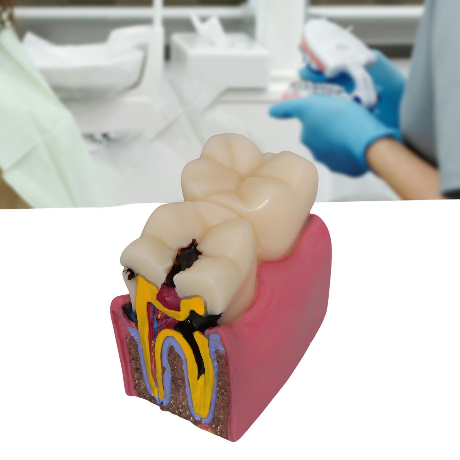 Kids Education Classes - Modelo de caries dental, utilería de