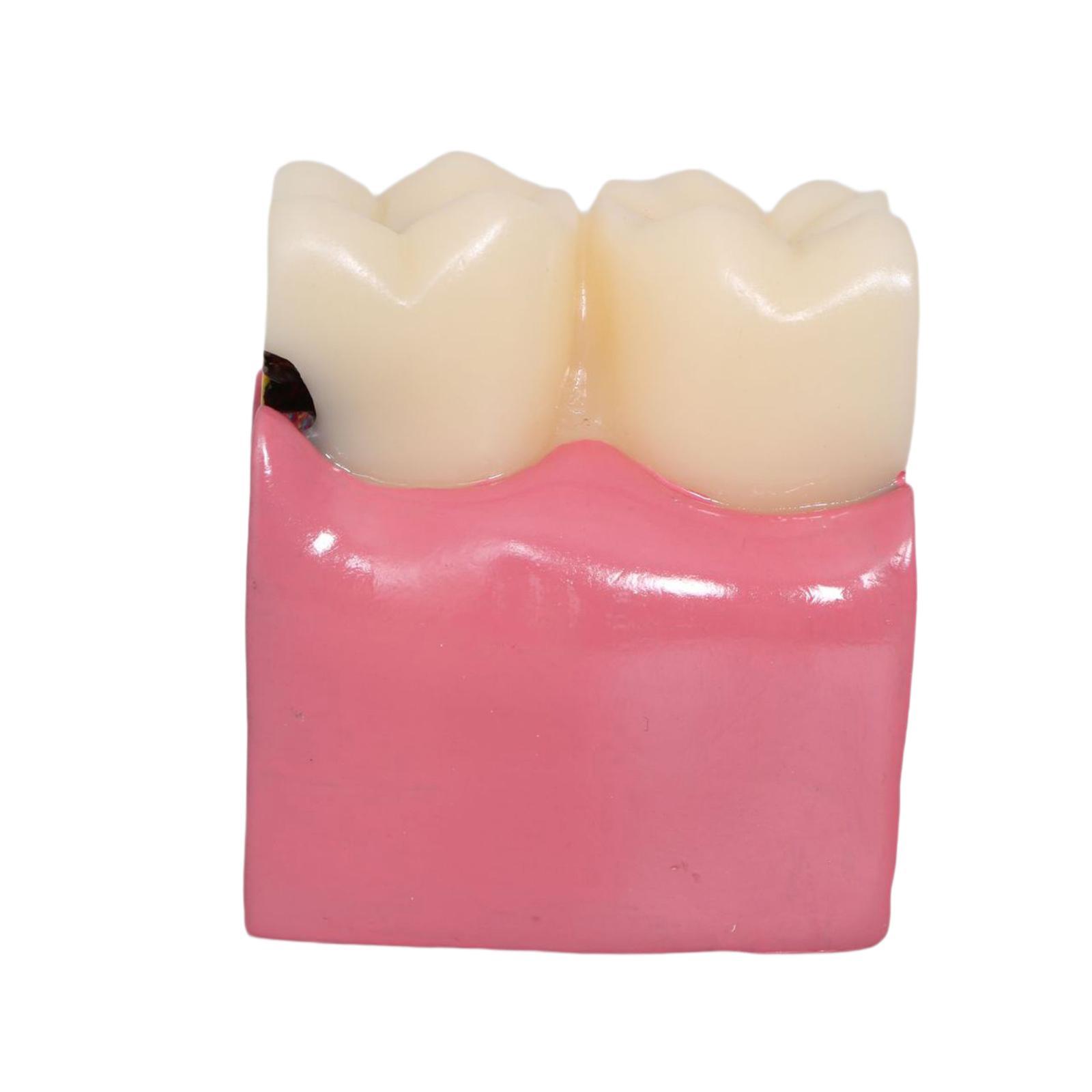 Modelo de caries dental, utile - Kids Education Classes reseña y precio
