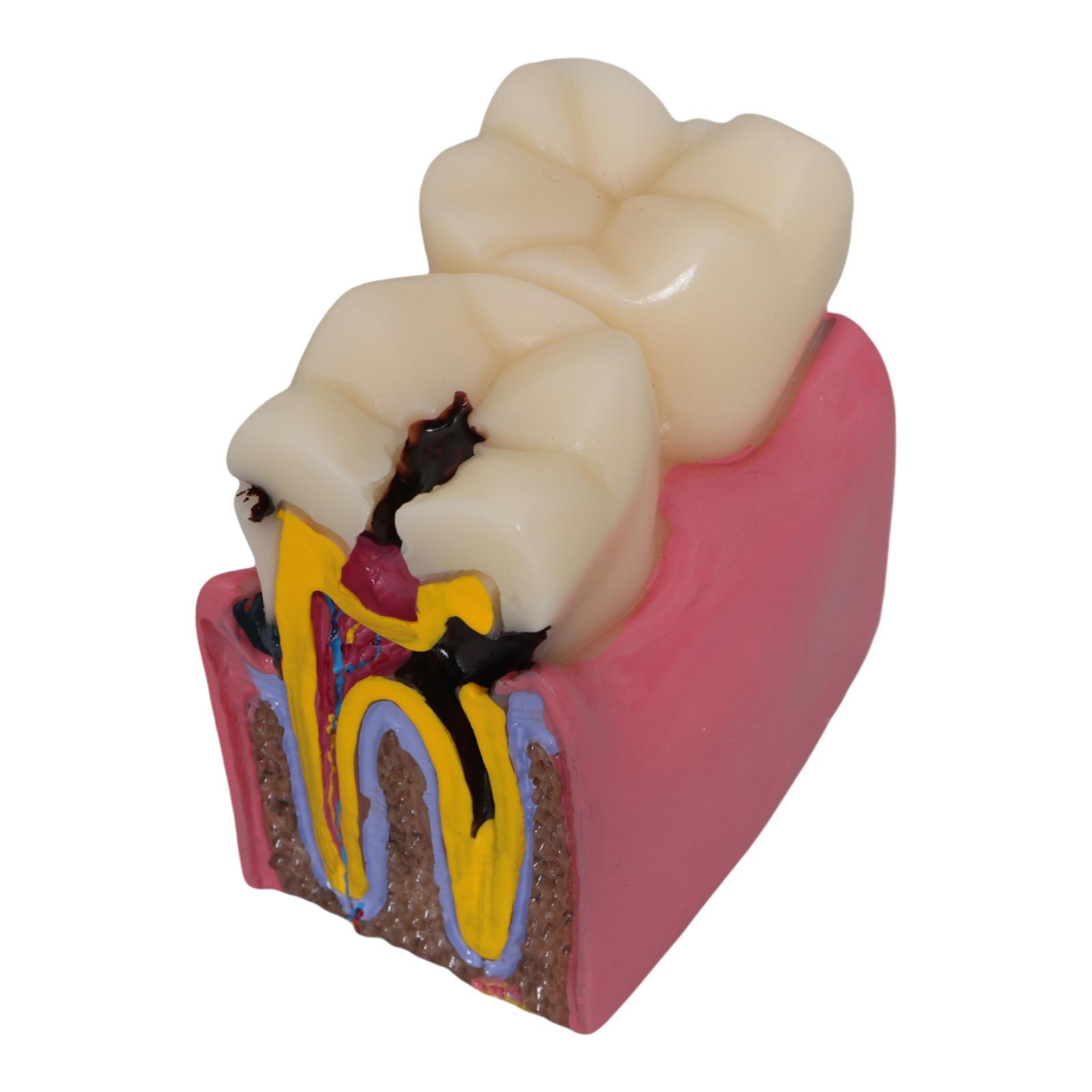 Modelo de caries dental, utile - Kids Education Classes reseña y precio